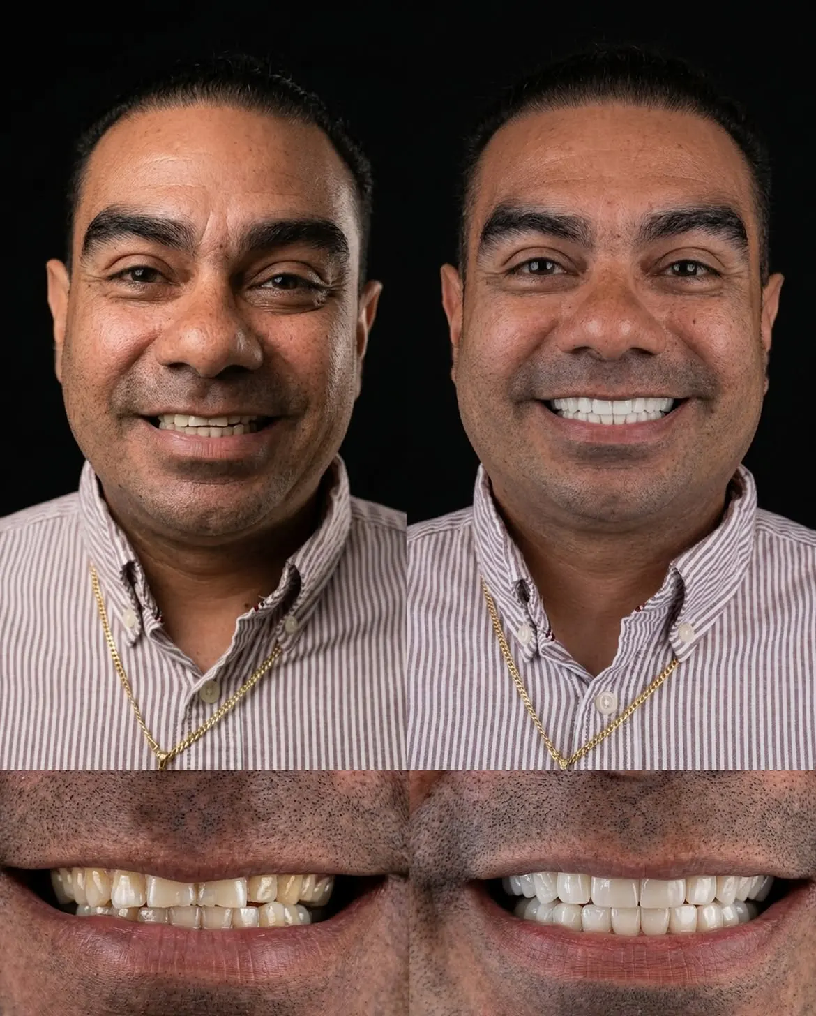 Before and after porcelain veneers, Xiluet patient, Miami