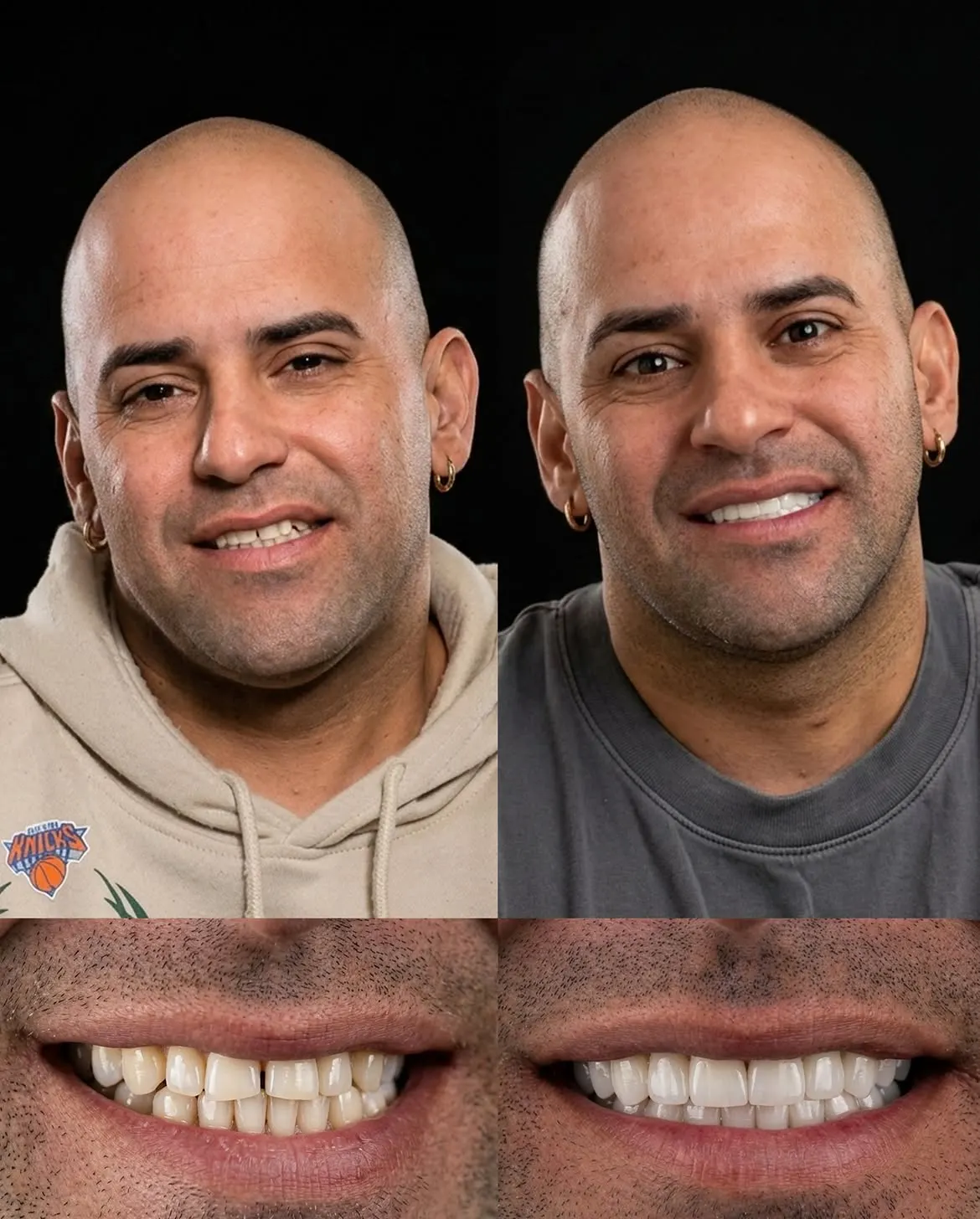 Before and after porcelain veneers, Xiluet patient, Miami