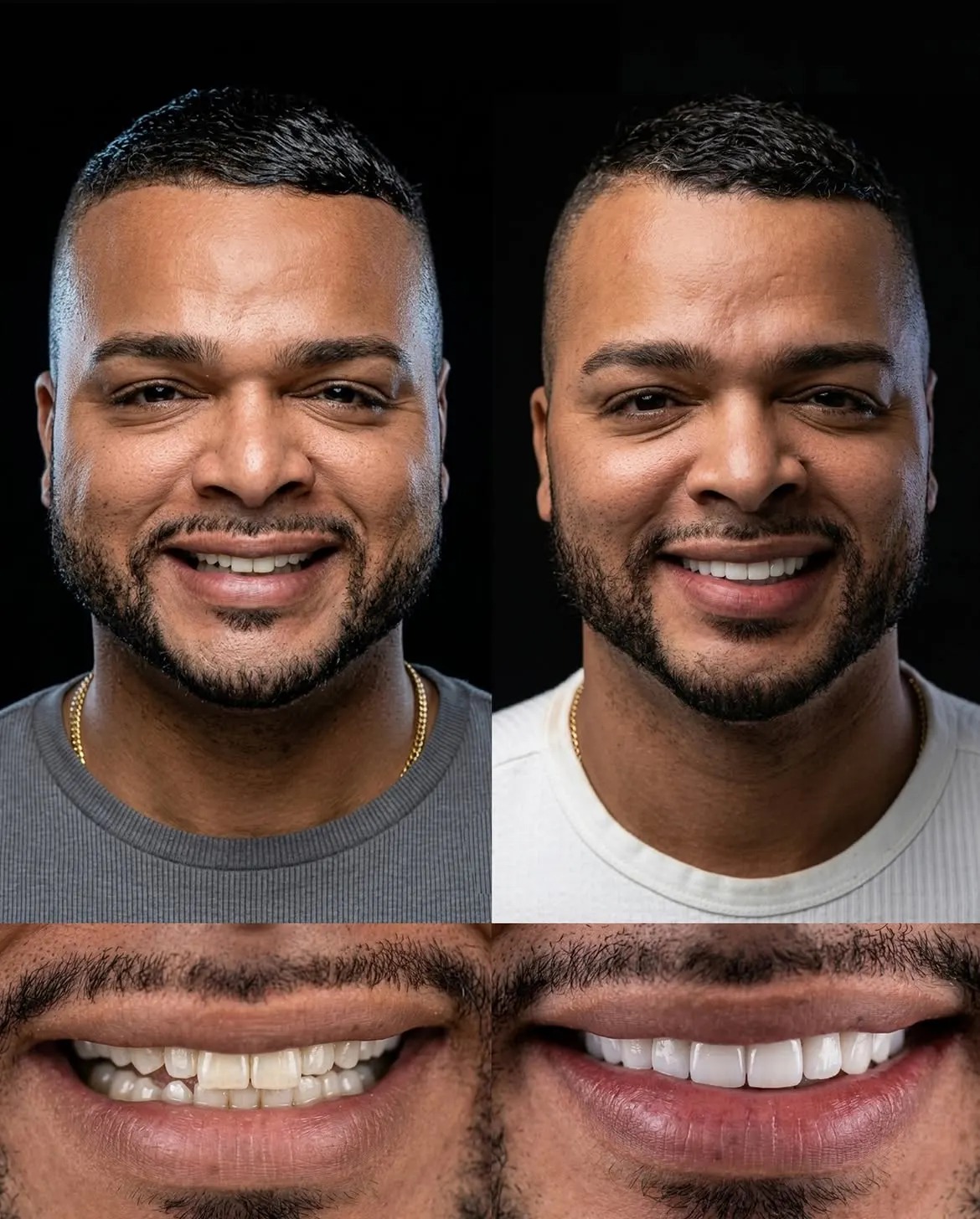 Before and after porcelain veneers, Xiluet patient, Miami