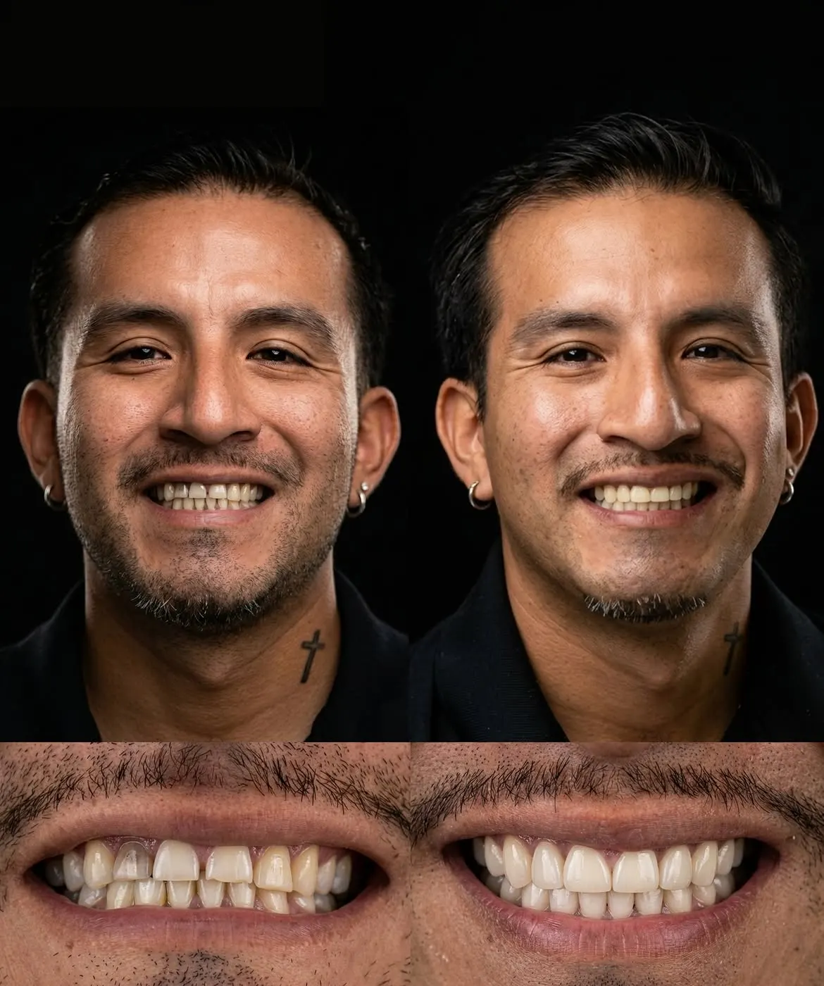 Before and after porcelain veneers, Xiluet patient, Miami