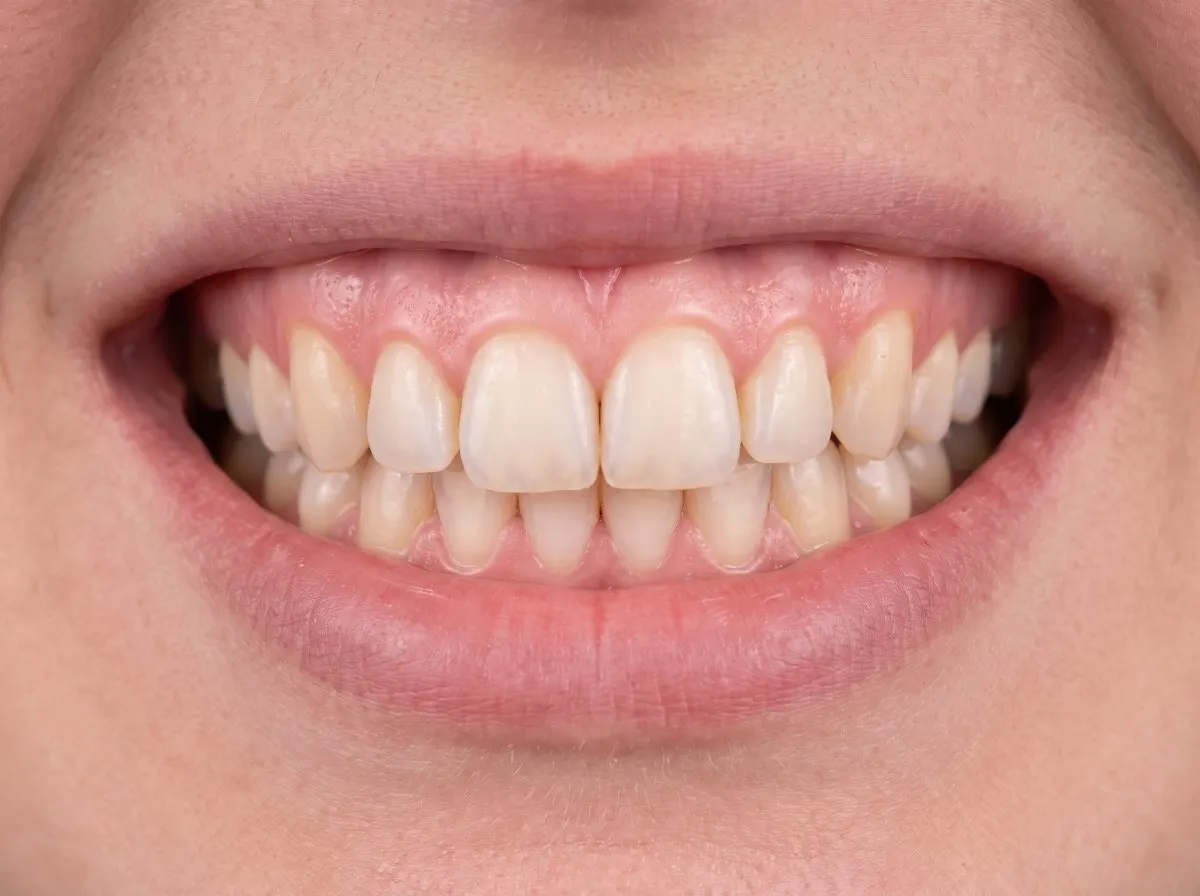Example: Front smile