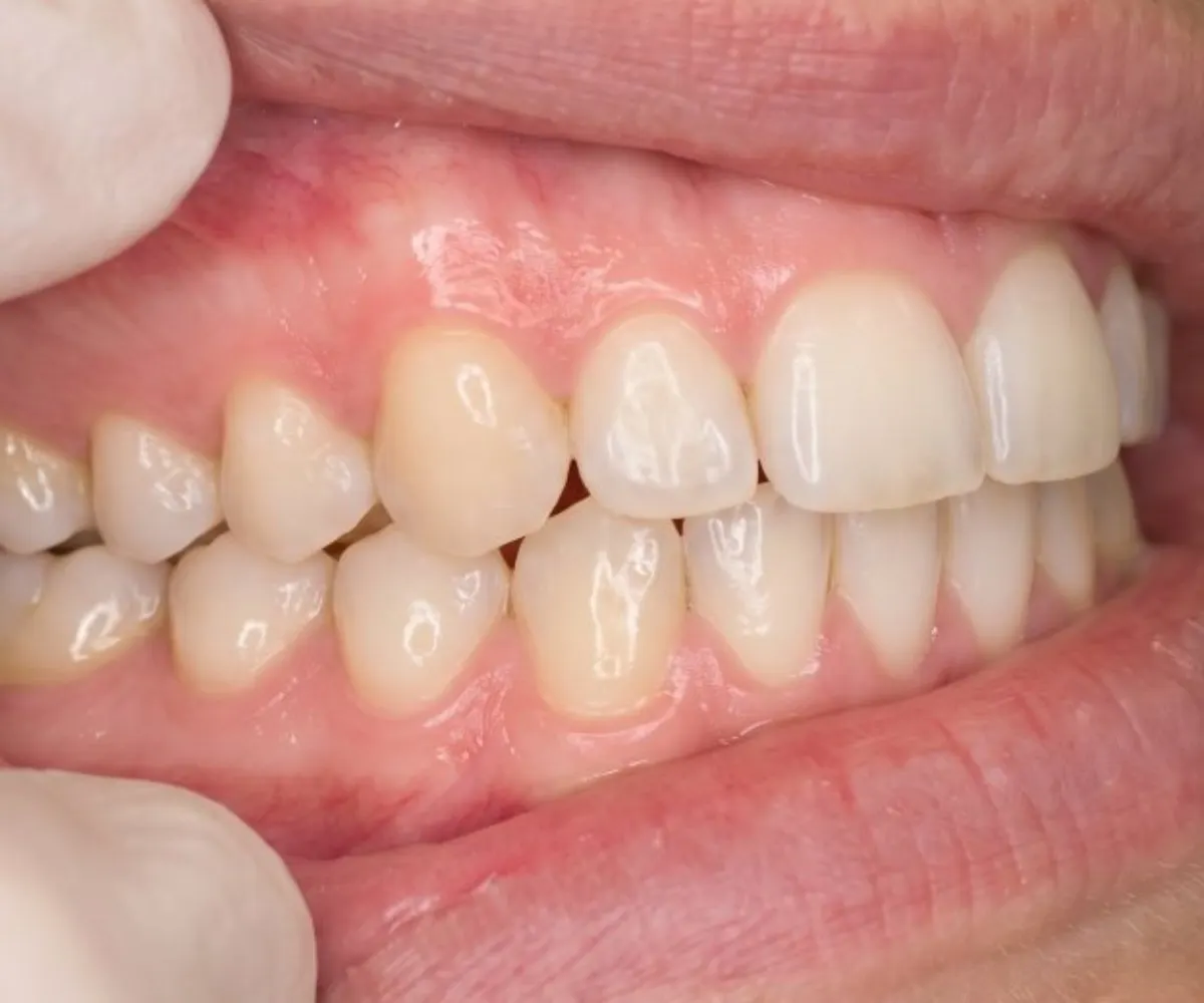 Example: Left side