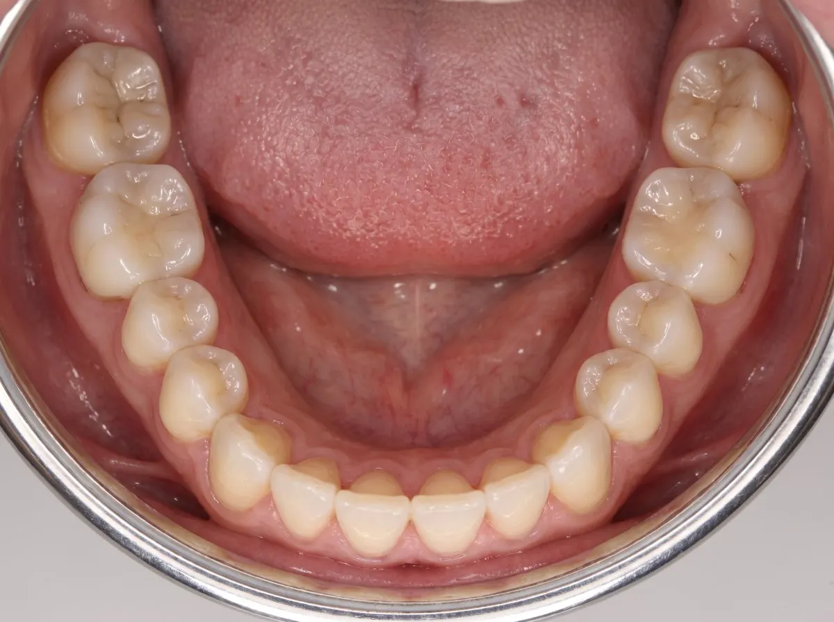 Example: Lower arch