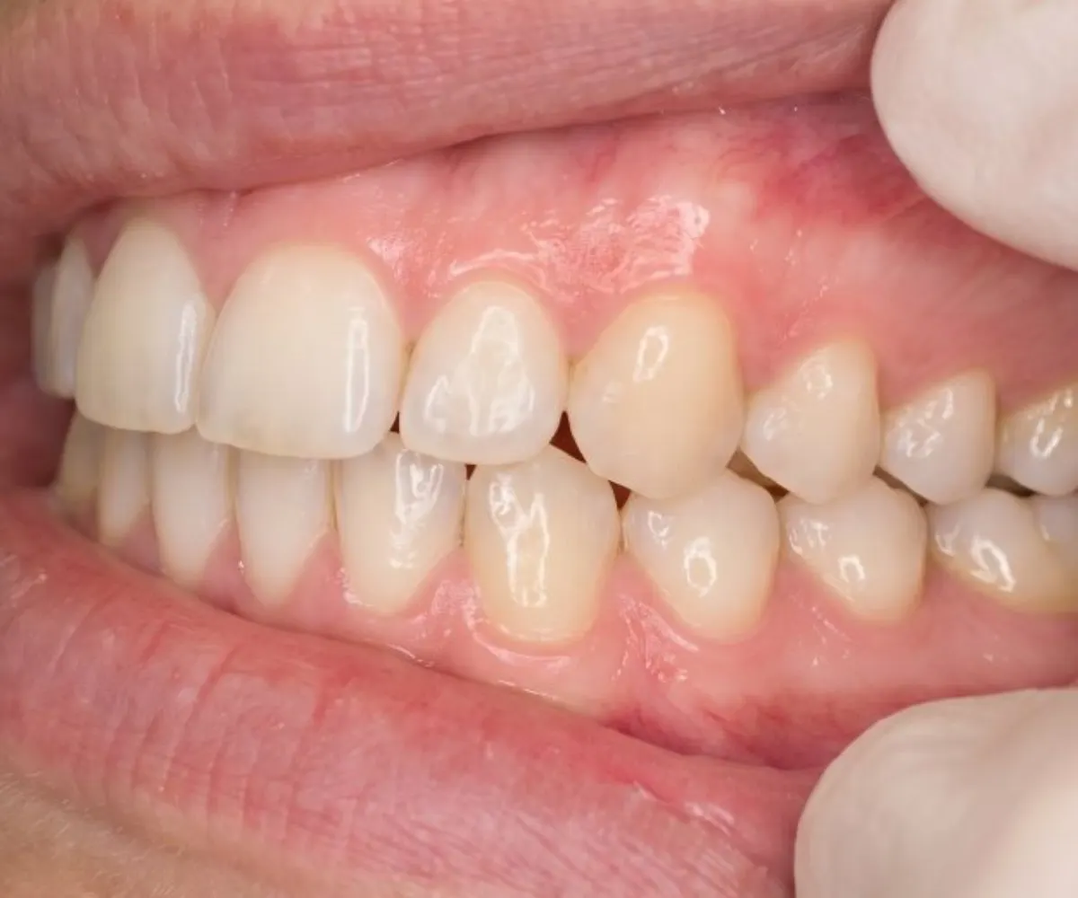 Example: Right side