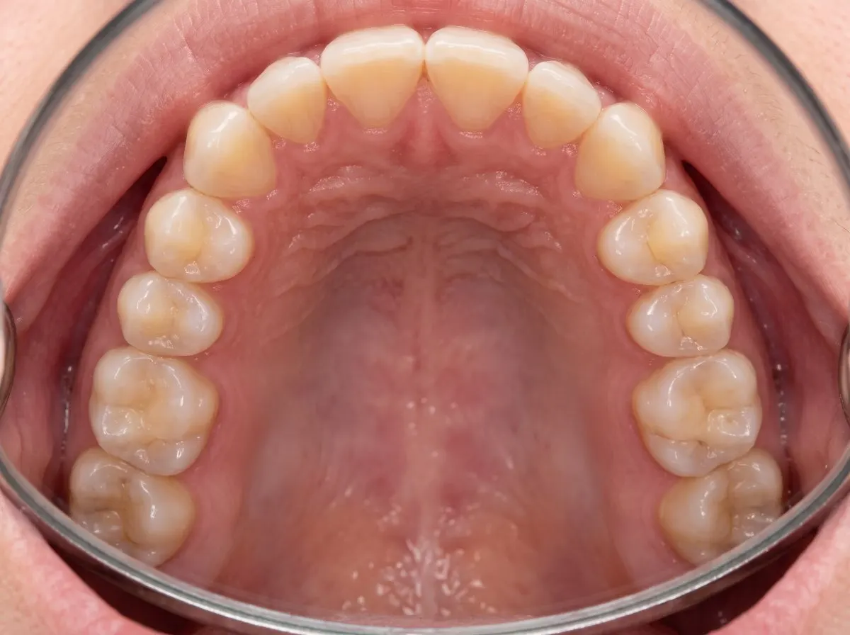Example: Upper arch